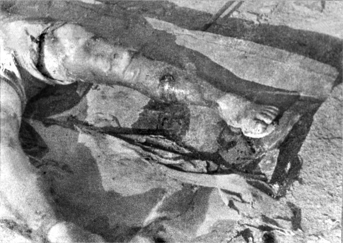 焼けただれた被爆者の脚＝1945年8月10日から17日の間