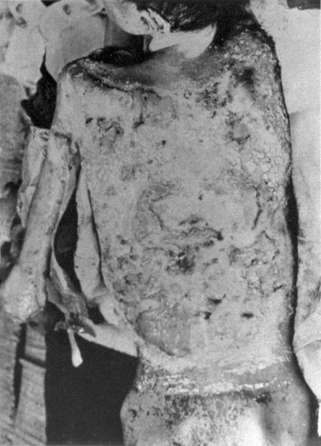 被爆した子供のケロイド。敗戦後まもなく米軍調査団が持ち帰り、
          病理標本、組織標本などとともにワシントンの米陸軍病理学研究所に保管されていた原爆資料の写真