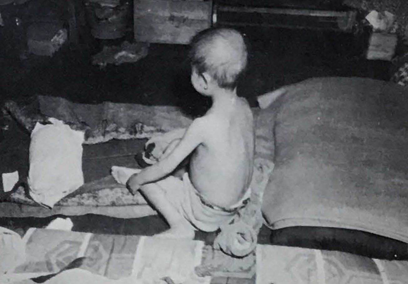 米海軍調査団の報告書にある長崎の被爆者の写真。頭に部分的な脱毛があるとし、左の肩と腕にある火傷が治癒していると説明している（国家安全保障公文書館提供）